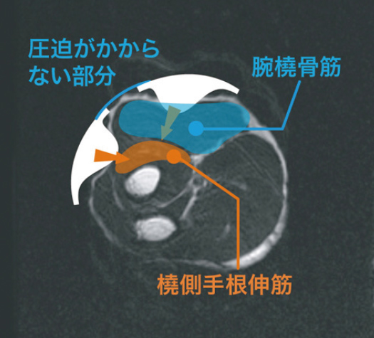 装着時のMRI画像